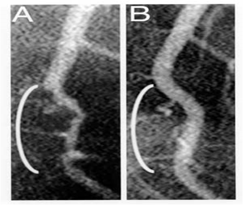 A- Coronary angiogram of clogged arteries before study. B- Coronary angiogram after 32 weeks on a cholesterol-free diet. The scientific evidence is very clear. From Prevent and Reverse Heart Disease by Caldwell Esselstyn, MD