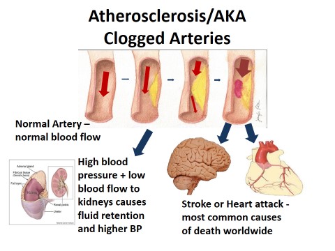 Atherosclerosis AKA clogged arteries